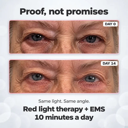 Eyloria® 2-in-1 Red Light Therapy + EMS To Erase Eye Bags