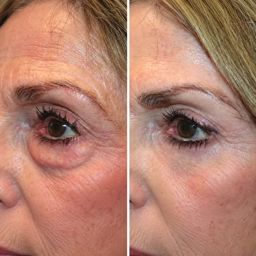 Eyloria® 2-in-1 Red Light Therapy + EMS To Erase Eye Bags